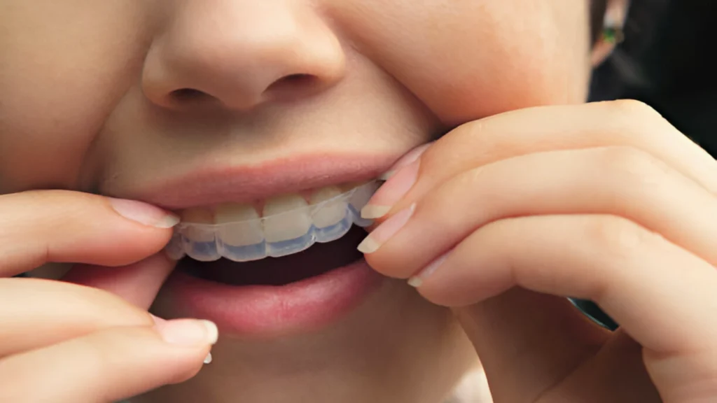 Clear Aligner Treatment in Thalassery