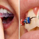 Clear Aligners VS Braces