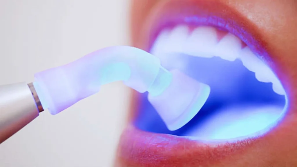 Laser Dental Treatments in Thalassery
