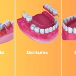 Dental Implants vs. Dentures vs. Bridges