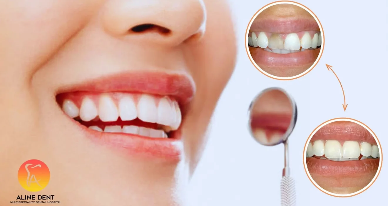 Smile Makeover Before & After