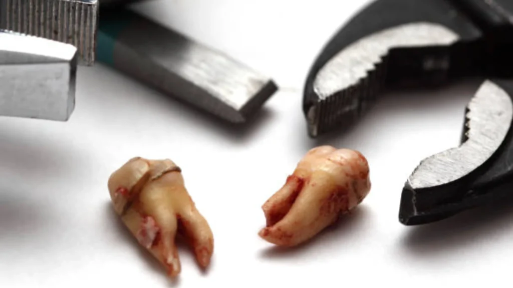 Wisdom Tooth Extraction in Thalassery