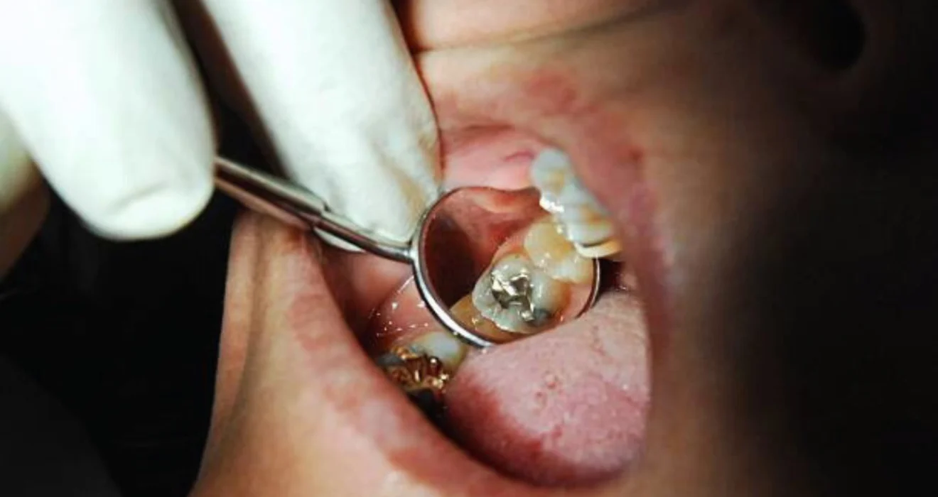 How to Remove Cavity from Teeth