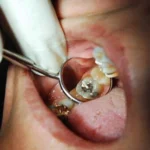 How to Remove Cavity from Teeth