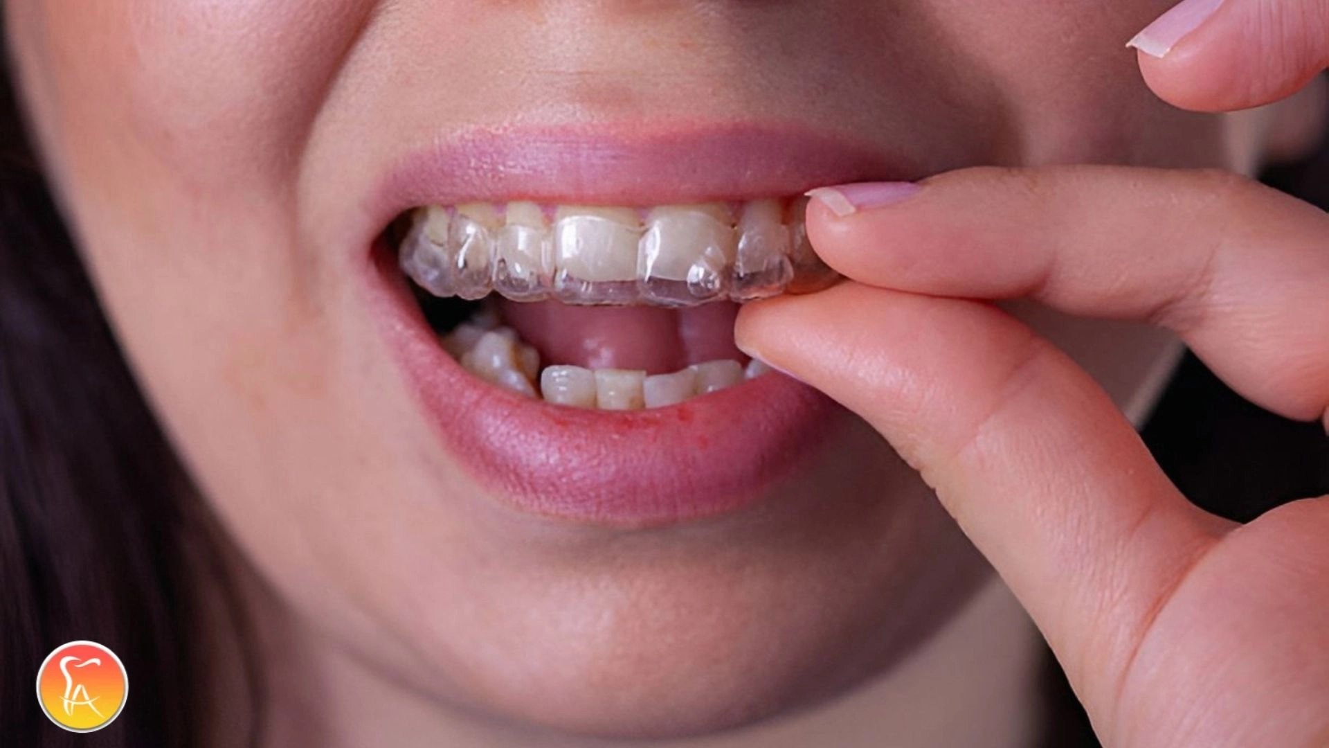 Do Clear Aligners Hurt? What You Really Need to Know Before Starting ...
