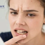 How to Remove Tartar from Teeth Without Dentist
