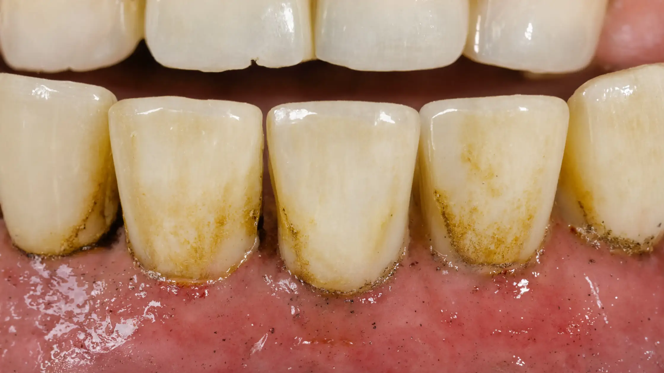 Reduce Tartar Buildup