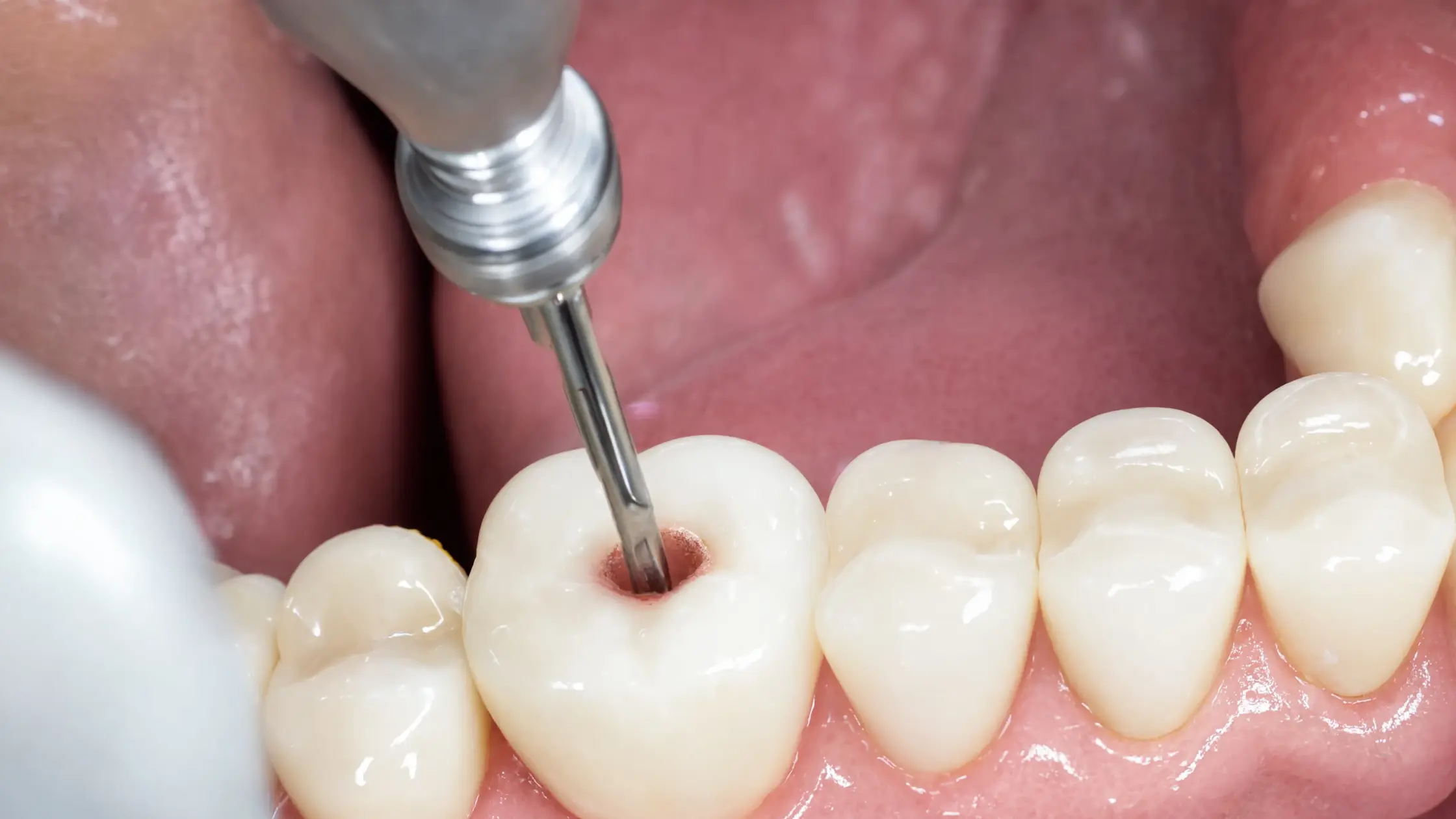 Root Canal Procedure