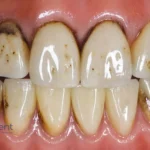 Dark Spots on Teeth