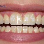White Spots on Teeth