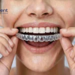 Do Clear Aligners Work for Overbites