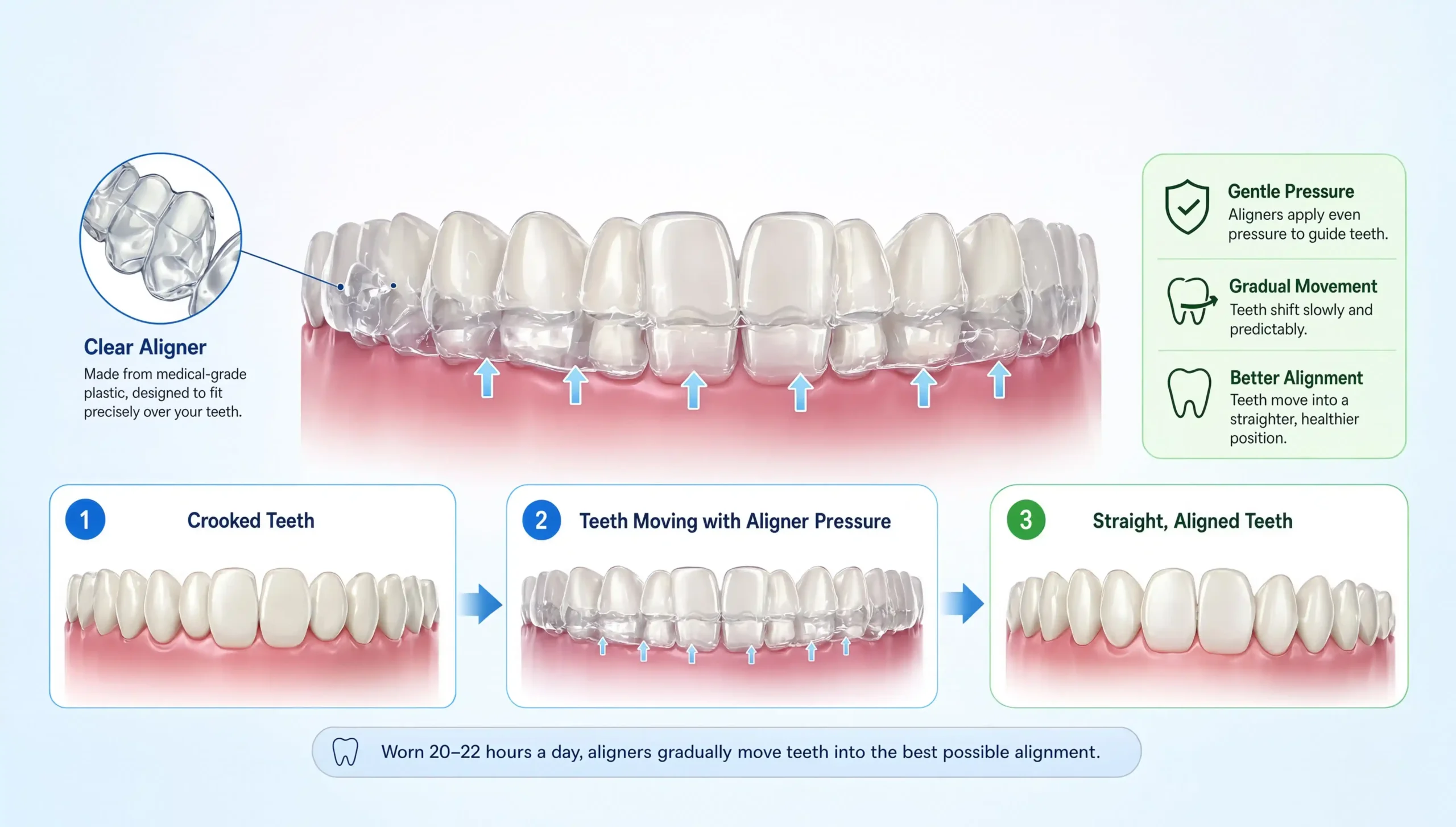 How Do Invisible Aligners Work