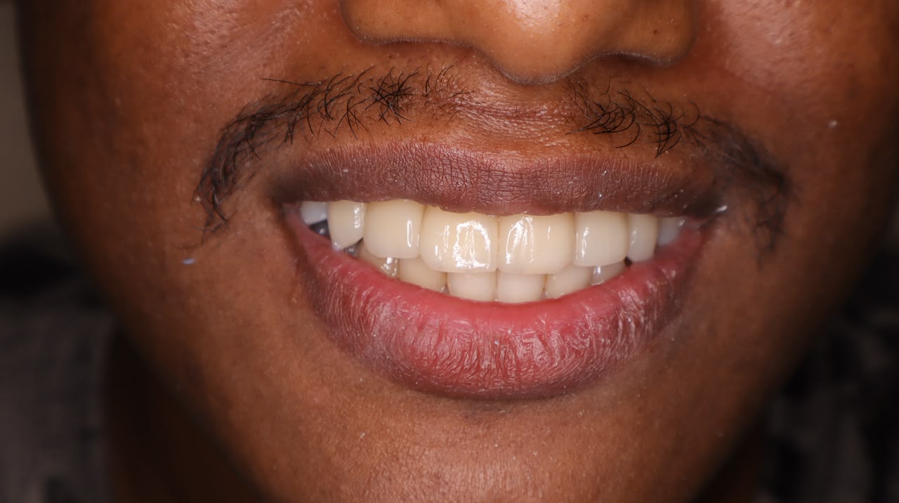 After treatment