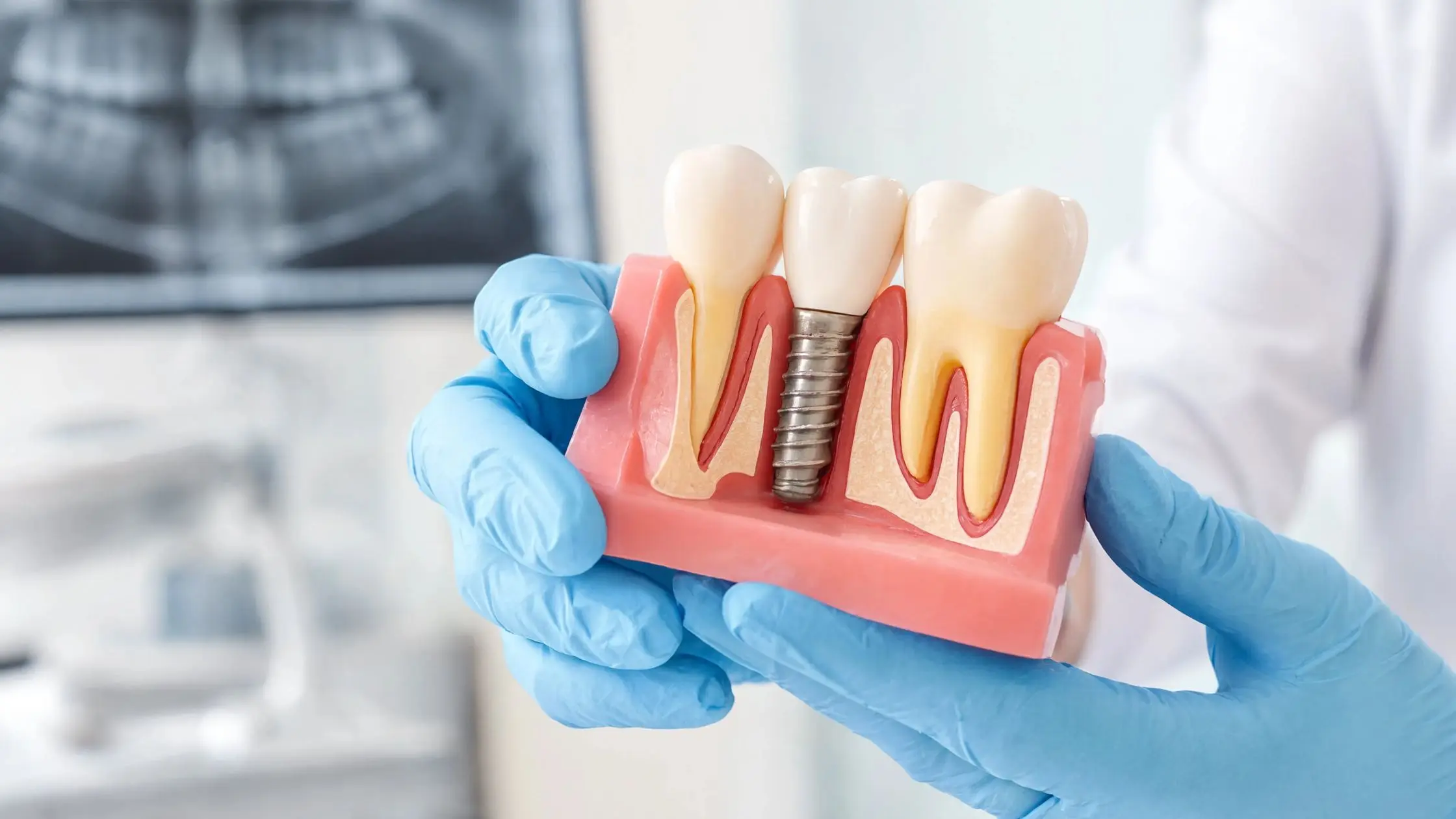 Dental Implants
