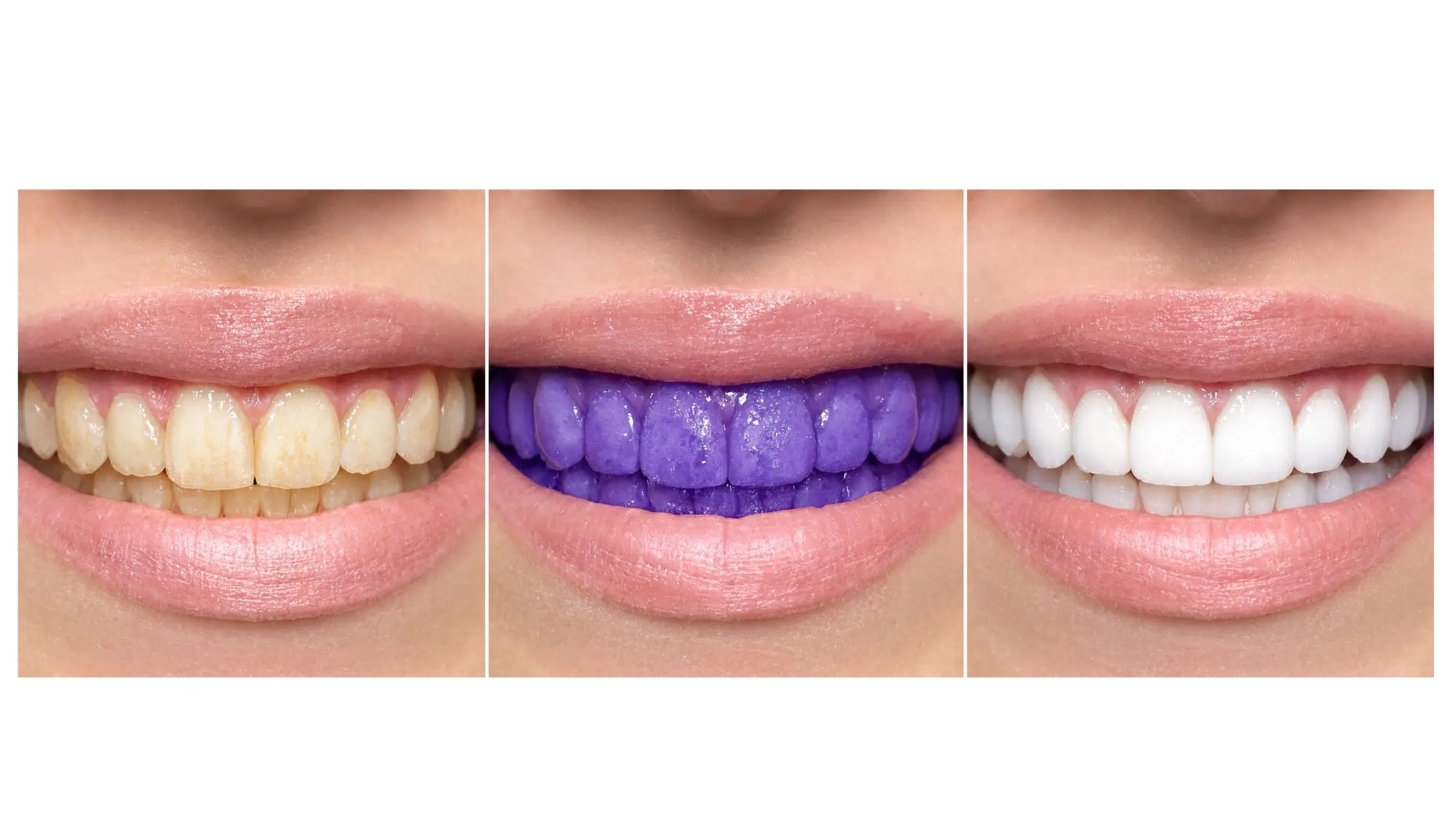 Purple Teeth Whitening Before and After