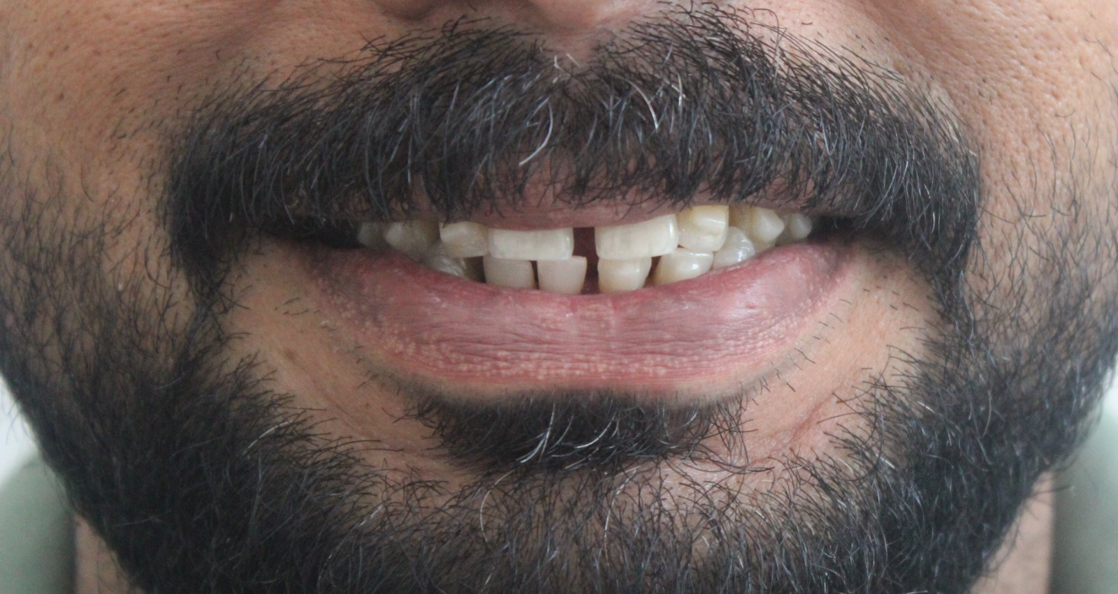 Teeth alignment & gap before treatment