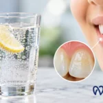 Can Sparkling Water Damage Your Teeth