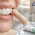Do Teeth Whitening Strips Damage Teeth